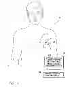 Fig. 02 - Systems and methods for using pulmonary artery pressure from an implantable sensor to detect mitral regurgitation and optimize pacing delays