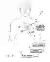 Fig. 03 - Systems and methods for using pulmonary artery pressure from an implantable sensor to detect mitral regurgitation and optimize pacing delays