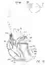 Fig. 17 - Systems and methods for using pulmonary artery pressure from an implantable sensor to detect mitral regurgitation and optimize pacing delays