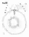 Fig. 23 - Analgesic implant device and system