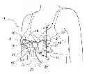 Fig. 01 - Bra With Integrated Breast Pump