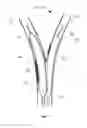 Fig. 02 - Method and a balloon catheter assembly for treating bifurcation lesions