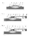 Fig. 02 - Method for vacuum therapy of wounds