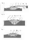 Fig. 03 - Method for vacuum therapy of wounds