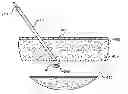 Fig. 01 - Hemostasis-enhancing device and method for its use