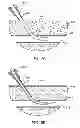 Fig. 06 - Hemostasis-enhancing device and method for its use