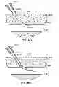 Fig. 09 - Hemostasis-enhancing device and method for its use