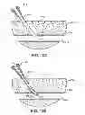 Fig. 13 - Hemostasis-enhancing device and method for its use