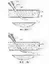 Fig. 16 - Hemostasis-enhancing device and method for its use