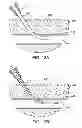 Fig. 19 - Hemostasis-enhancing device and method for its use