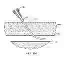 Fig. 23 - Hemostasis-enhancing device and method for its use