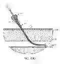 Fig. 25 - Hemostasis-enhancing device and method for its use