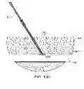 Fig. 26 - Hemostasis-enhancing device and method for its use