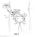Fig. 03 - Urgency therapy with neuromodulation and C-afferent nerve desensitization
