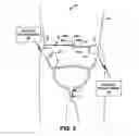 Fig. 04 - Urgency therapy with neuromodulation and C-afferent nerve desensitization