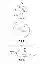 Fig. 03 - Method for creating incision to improve intraocular lens placement