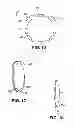 Fig. 09 - Method for creating incision to improve intraocular lens placement