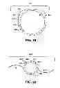 Fig. 10 - Method for creating incision to improve intraocular lens placement