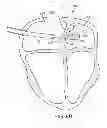 Fig. 11 - Apparatus and methods for retracting a catheter balloon