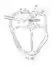 Fig. 12 - Apparatus and methods for retracting a catheter balloon