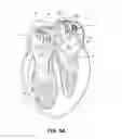 Fig. 04 - ABLATION THERAPY SYSTEM AND METHOD FOR TREATING CONTINUOUS ATRIAL FIBRILLATION