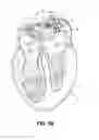 Fig. 05 - ABLATION THERAPY SYSTEM AND METHOD FOR TREATING CONTINUOUS ATRIAL FIBRILLATION