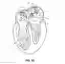 Fig. 07 - ABLATION THERAPY SYSTEM AND METHOD FOR TREATING CONTINUOUS ATRIAL FIBRILLATION
