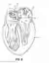 Fig. 08 - ABLATION THERAPY SYSTEM AND METHOD FOR TREATING CONTINUOUS ATRIAL FIBRILLATION