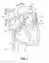 Fig. 09 - ABLATION THERAPY SYSTEM AND METHOD FOR TREATING CONTINUOUS ATRIAL FIBRILLATION