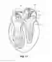 Fig. 14 - ABLATION THERAPY SYSTEM AND METHOD FOR TREATING CONTINUOUS ATRIAL FIBRILLATION
