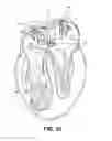 Fig. 15 - ABLATION THERAPY SYSTEM AND METHOD FOR TREATING CONTINUOUS ATRIAL FIBRILLATION