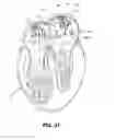 Fig. 17 - ABLATION THERAPY SYSTEM AND METHOD FOR TREATING CONTINUOUS ATRIAL FIBRILLATION