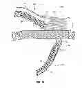 Fig. 14 - Magnetically coupling devices for mapping and/or ablating