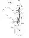 Fig. 01 - MULTICHANNEL CANNULA  AND METHODS FOR USING SAME