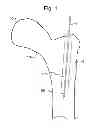 Fig. 02 - MULTICHANNEL CANNULA  AND METHODS FOR USING SAME