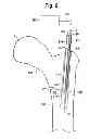 Fig. 05 - MULTICHANNEL CANNULA  AND METHODS FOR USING SAME