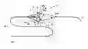 Fig. 01 - INSTRUMENT FOR CAPTURING FREE THROMBI