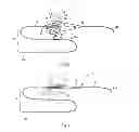 Fig. 03 - INSTRUMENT FOR CAPTURING FREE THROMBI
