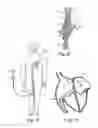 Fig. 03 - Catch Member for PFO Occluder