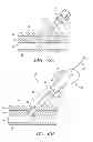Fig. 04 - Sheath apparatus and methods for delivering a closure device