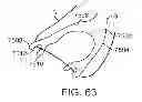 Fig. 49 - Knotless suture anchor and methods of use