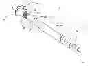 Fig. 01 - Distal bone anchors for bone fixation with secondary compression