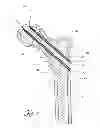 Fig. 02 - Distal bone anchors for bone fixation with secondary compression