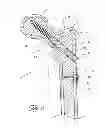 Fig. 12 - Distal bone anchors for bone fixation with secondary compression