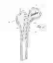 Fig. 16 - Distal bone anchors for bone fixation with secondary compression