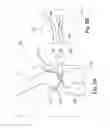 Fig. 10 - Guide tool for cartilage repair