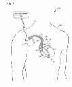 Fig. 02 - Cardiac therapy based upon impedance signals