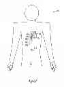 Fig. 12 - Modular antitachyarrhythmia therapy system
