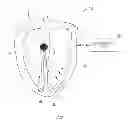 Fig. 06 - Methods and apparatus for predicting acute response to cardiac resynchronization therapy at a given stimulation site