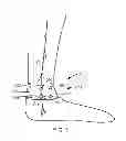 Fig. 04 - Tibial nerve stimulation therapy device calibration